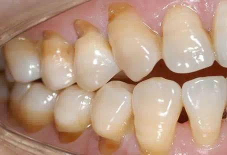 牙齿快被刷断了!_患者_牙刷_颈部