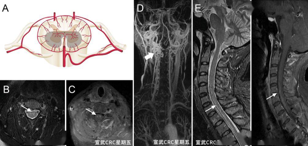 宣武crc星期五|脑血管造影后的截瘫_患者_脊髓_上肢