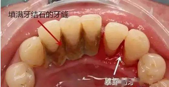 我的牙齿就靠牙石撑着了