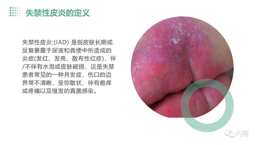 【ppt】失禁性皮炎患者的护理_直播_文库_闪得