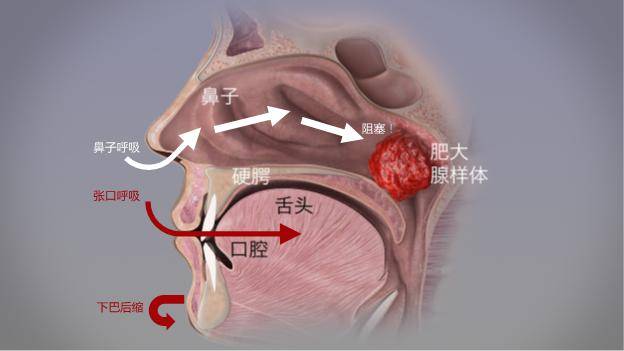 睡觉时张口呼吸会变丑?这种办法火了!医生:胡来.