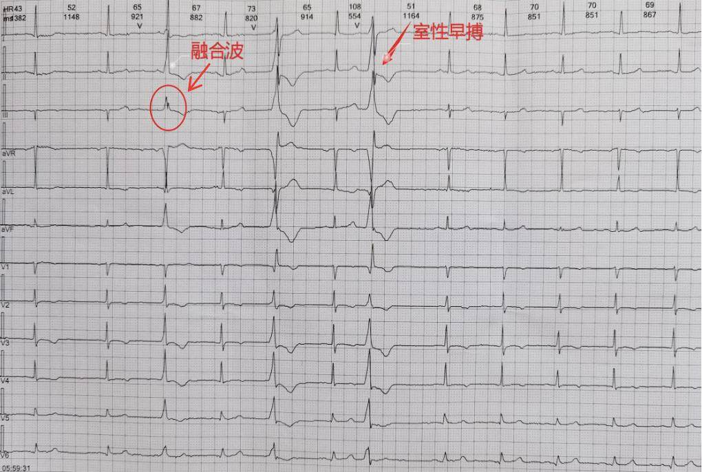 室上性心律心电图特征图片