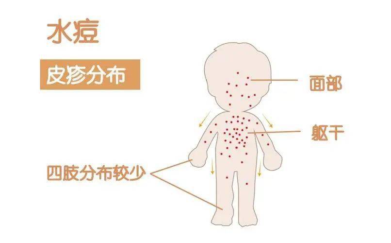 主要症狀:水痘病毒感染人體後,經過大約2周的潛伏期,患者可出現頭痛