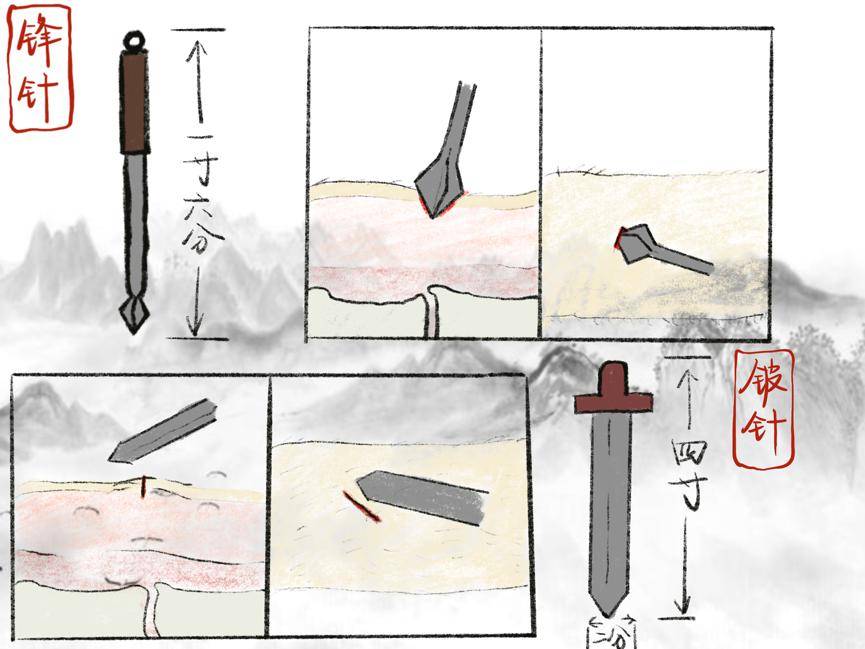 尖如牛氂刺痈肿,一寸六分莫惊恐.毫针常见用途广,微而久留以徐养.