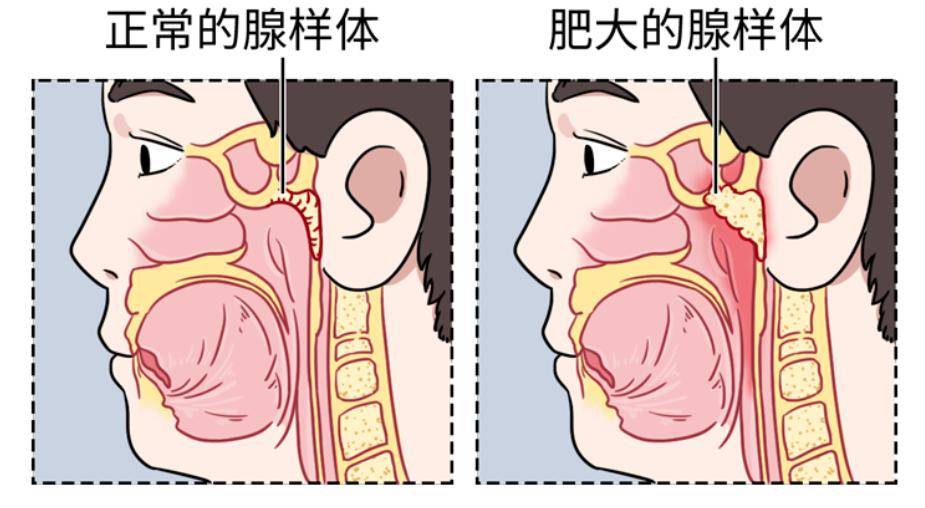 口腔健康 | 孩子"口呼吸" ?纠正攻略请查收~_阻塞_习惯性_问题