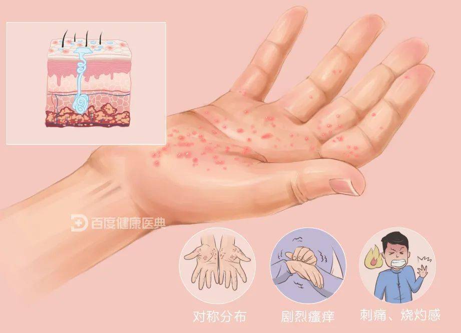 汗疱疹又称出汗不良性湿疹,是一种对称发生在手或脚的水疱性皮肤病