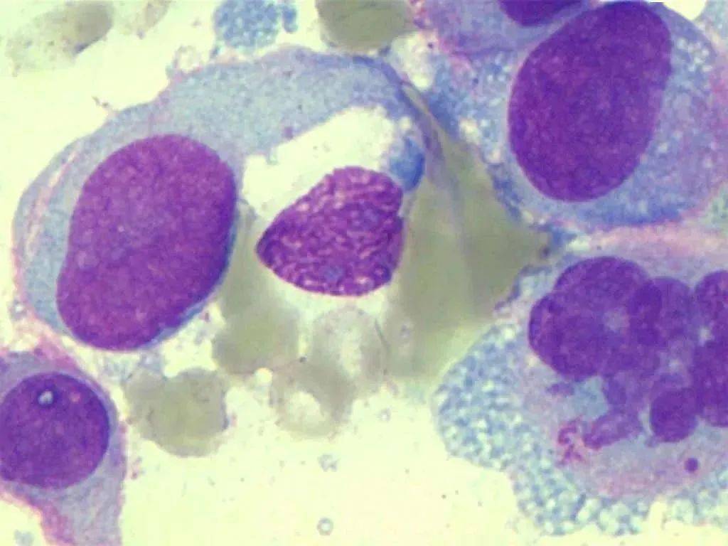 【病例分享】骨髓转移性恶性黑色素瘤_皮肤_临床_恶性肿瘤