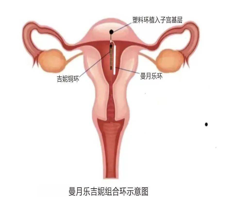 子宫的固定装置图片