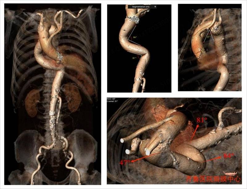 主动脉弓缩窄手术图片