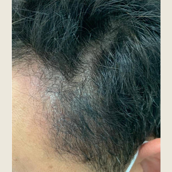 孕妇去屑止痒洗发水排行榜_头皮_问题_炎症