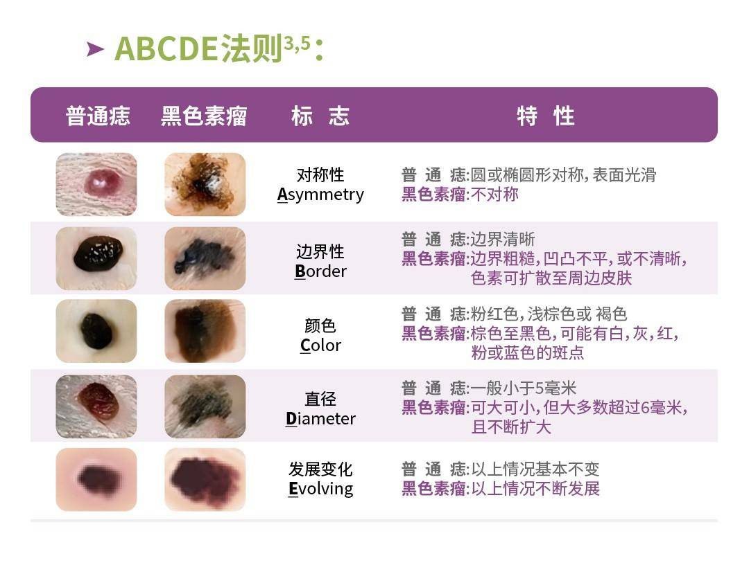 5初步自我判别,如果出现疑似症状,请快快到黑色素瘤规范治疗医院由