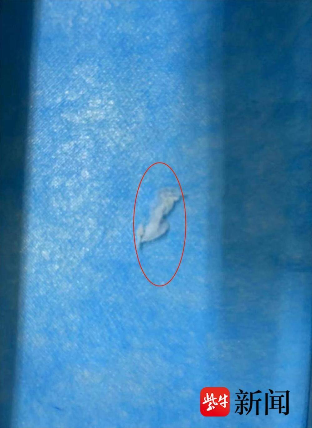 危险:3岁娃擤鼻涕把纸巾吸入鼻腔