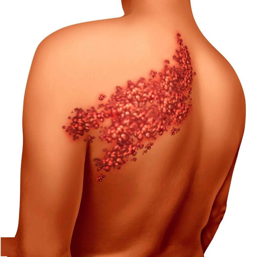 带状疱疹典型的体征是皮疹:先出现红斑,很快出现粟粒至黄豆大小丘疹