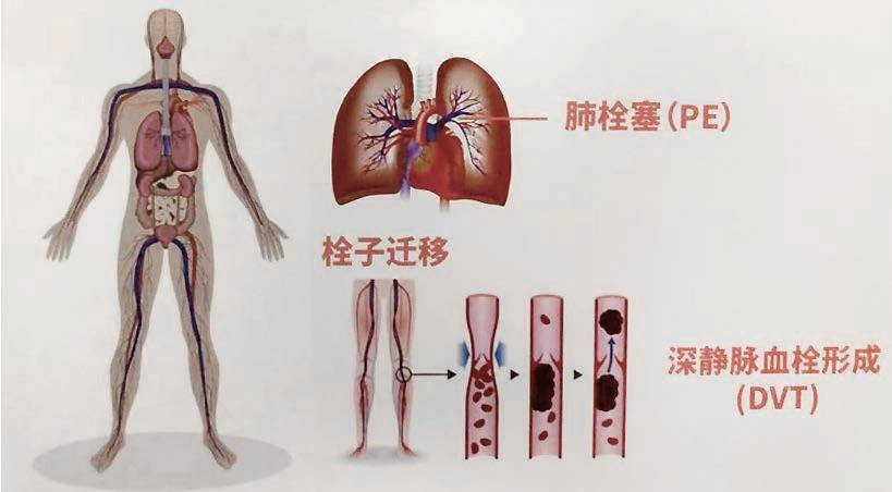 心肌梗死等急症,肺栓塞的诊断和治疗难度更大,主要原因是:1很多血栓