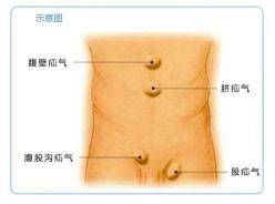 【预告】3月7日中国疝气日,疝和腹壁外科开展义诊活动