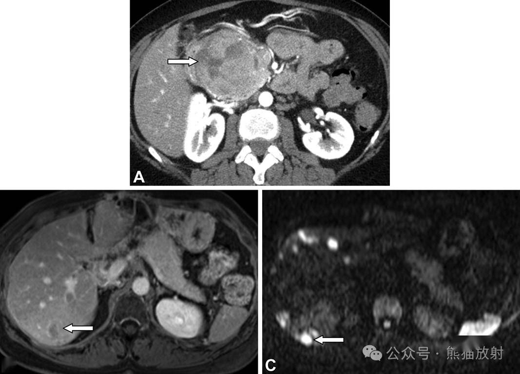 (a) 对比增强ct显示不均质强化的胰头肿块(箭).