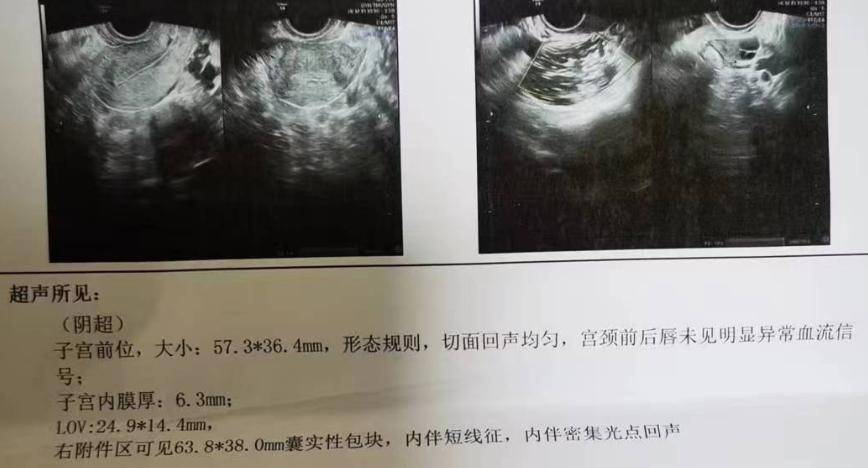 【真实案例】卵巢畸胎瘤要做手术吗?会影响卵巢功能吗?