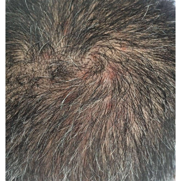 头皮_问题_效果