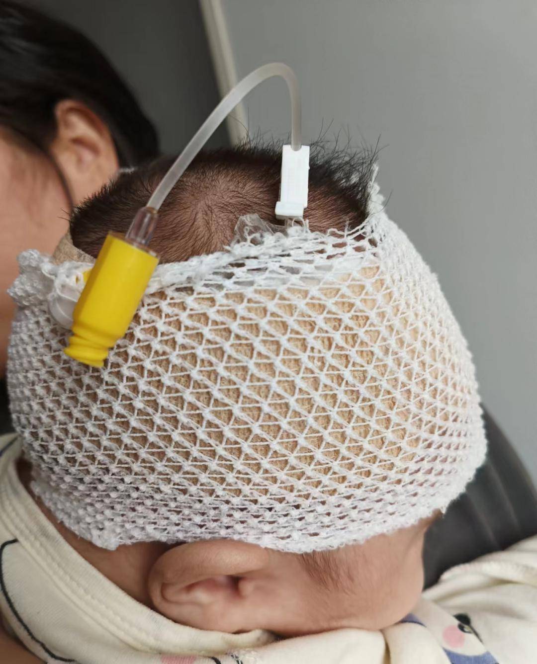 的几率,呼市妇幼保健院儿科使用弹力绷带,网帽对患儿输液部位进行保护