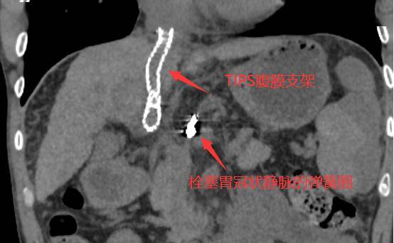 广南县首例TIPS成功开展, 打通肝硬化患者的“生命通道”_手机搜狐网