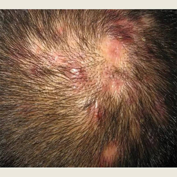 头部有毛囊炎用什么洗发水?