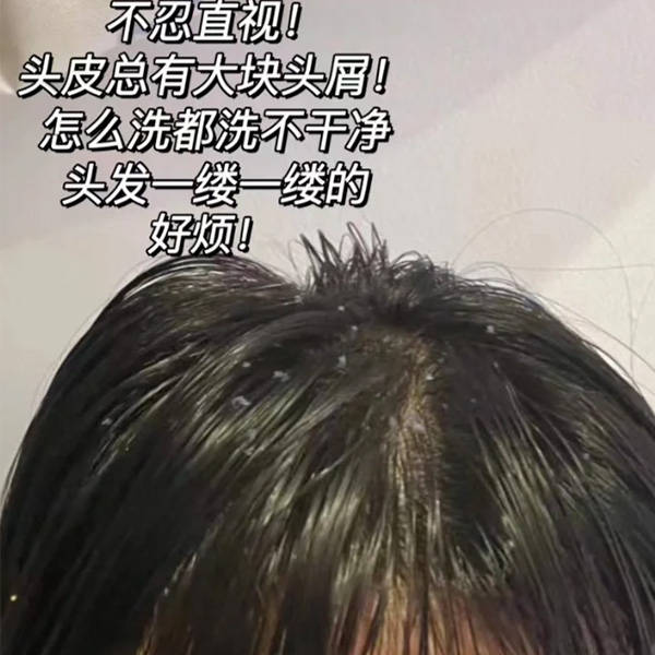 头皮_问题_头发