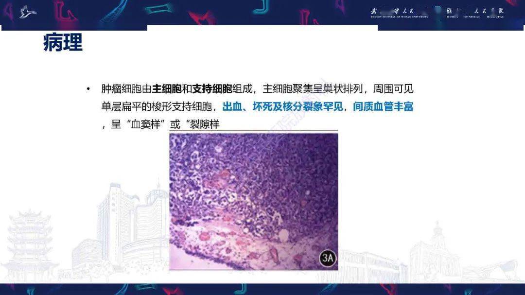 膀胱副神经节瘤影像诊断