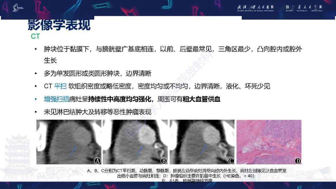 膀胱副神经节瘤影像诊断