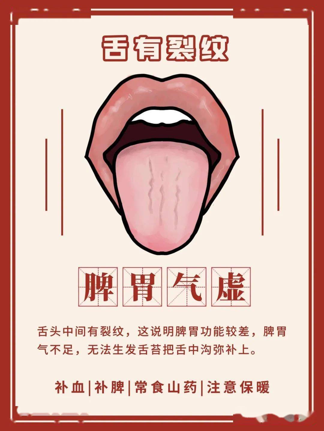 一张图带你看懂舌苔7种常见舌像看看你是什么体质