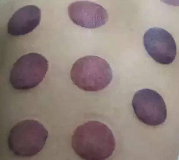 罐印辨证及如何调补