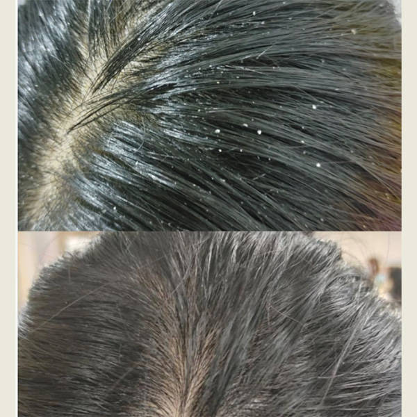 哪个洗发水去屑效果好用