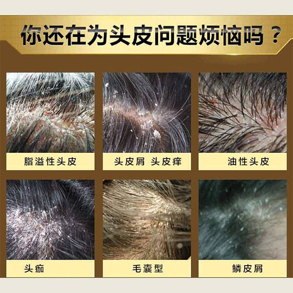问题_头皮屑_油脂