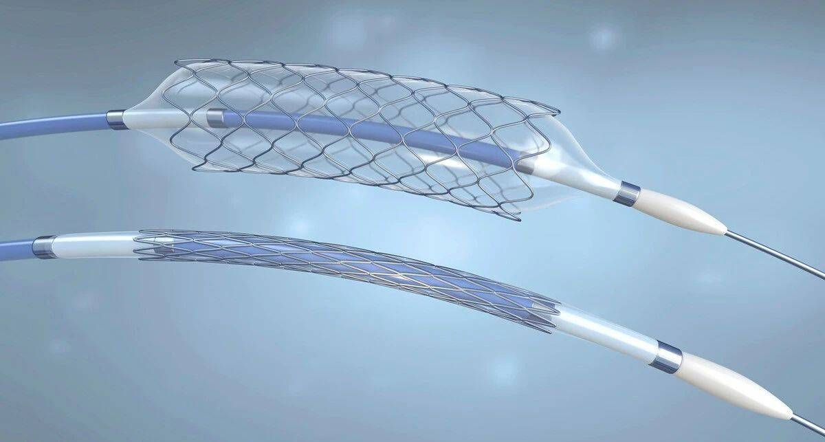 国家医保局 集采后新一代铬合金支架占比增至95%