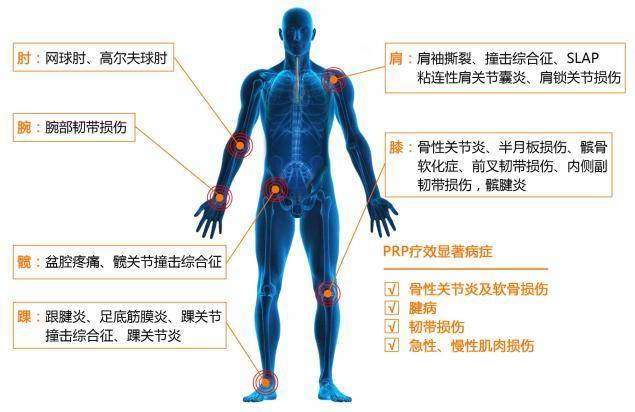 慢性肌腱炎,慢性肩痛,肩袖损伤,肌腱及韧带扭伤拉伤,足底筋膜炎,网球