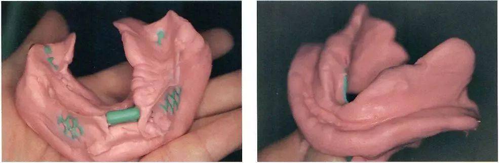 仅采集牙列,牙冠咬合面的印模是不够的,预备上颌印模还需要采集腭面