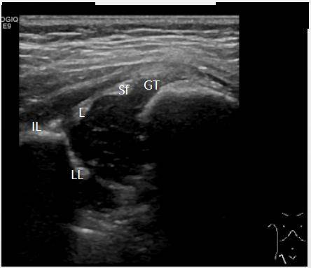 耻骨联合分离超声图片图片