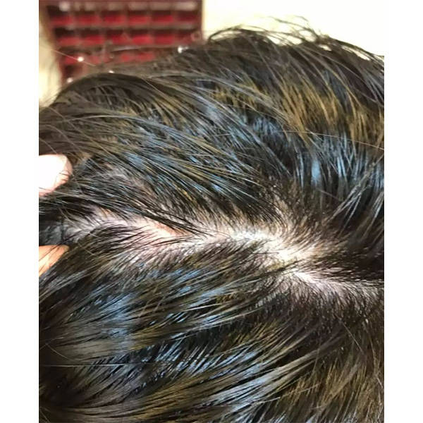 头发_头皮屑_效果