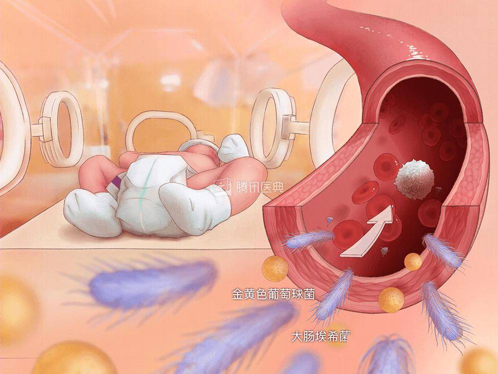 刚出生的宝宝脐部发红伴有分泌物警惕新生儿败血症
