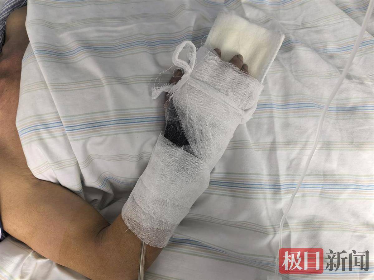 男子双手卷入传送带中受重伤,医生争分夺秒精细操作保肢保命_先生_进行_右手