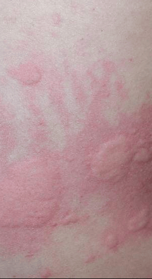 花粉过敏怎么办?