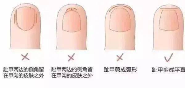 痛到灵魂出窍的甲沟炎拖着不管,等待你的可能是拔甲