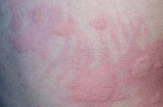 关于碘造影剂过敏反应你知道多少