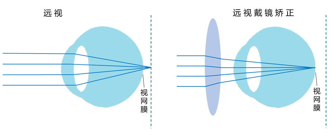 远视眼看到的图片图片