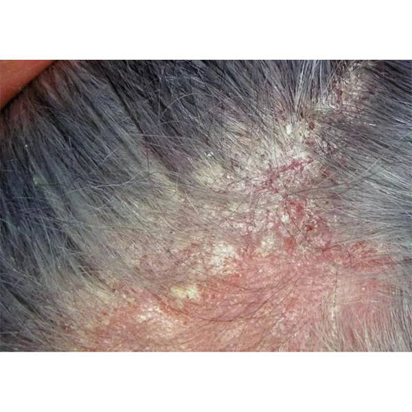 女性去头屑的洗发水