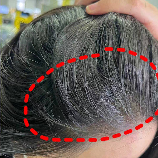 止痒消炎洗发水推荐_头发_去屑_问题