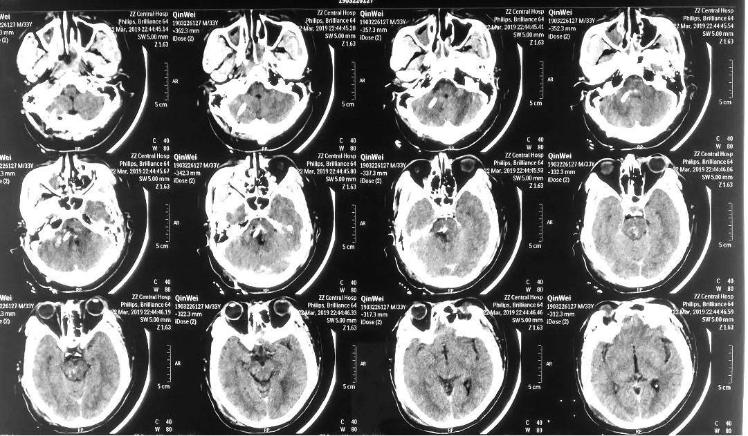 脑干出血的ct片子图片图片