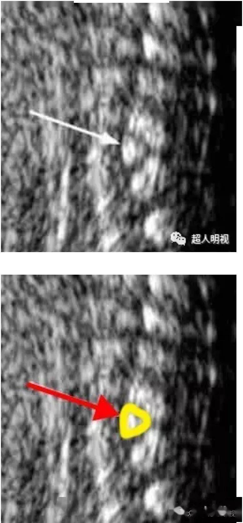 胎儿半椎体(hemivertebra)