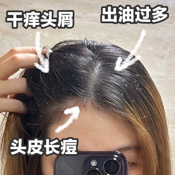 问题_头皮屑_成分