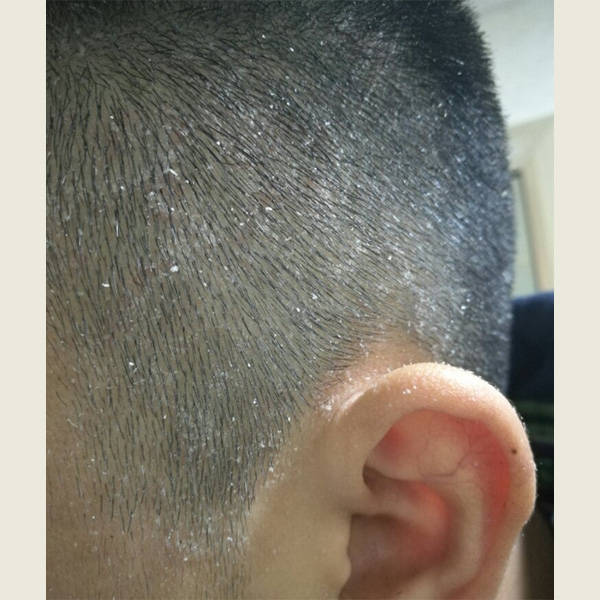 头发_头皮屑_问题