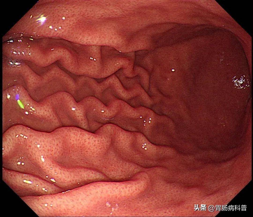 科学认识萎缩性胃炎,其实并不可怕!